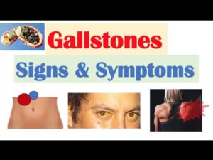 Gallbladder Stone Symptoms You Should Never Ignore in Delhi – PSRI Hospital Guide
