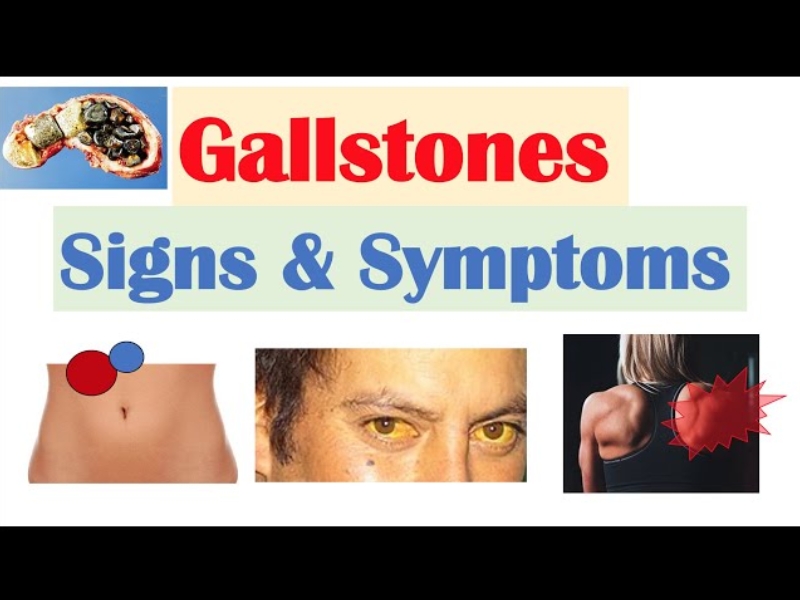 gallbladder stone symptoms and treatment