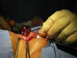 Hernia Surgery in Delhi: Symptoms and Treatment