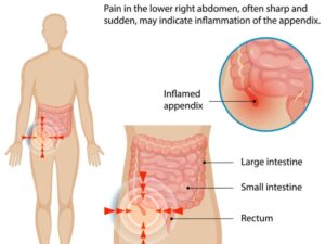 Appendix Pain (Appendicitis): Signs You Should Never Ignore | Dr. Prashant Kumar, New Delhi