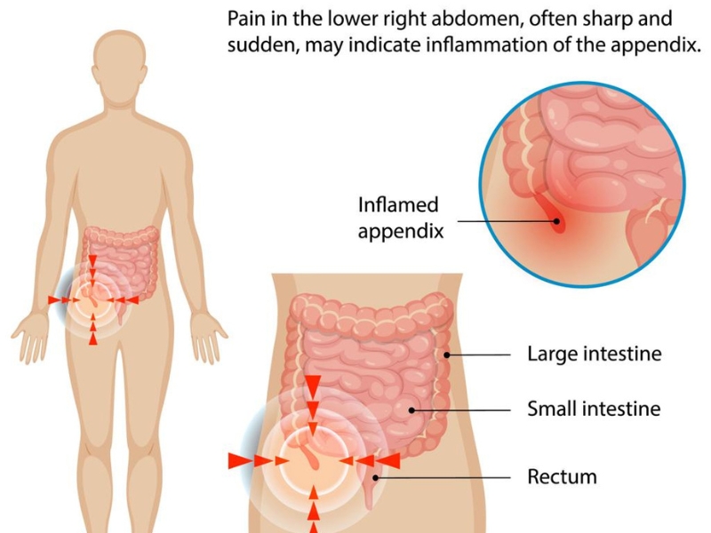 Appendix pain signs