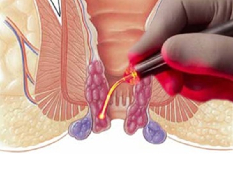 Laser treatment for piles