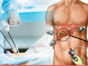 Gallbladder stone surgery in Delhi laparoscopic procedure