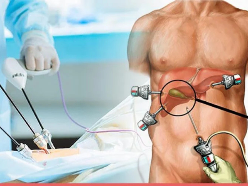 Gallbladder stone surgery in Delhi laparoscopic procedure