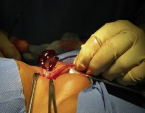 Patient consulting a surgeon for hernia surgery in Delhi