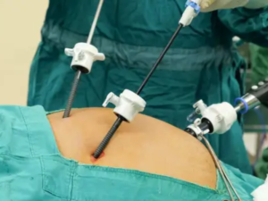 Gallbladder Stone Surgery in Delhi