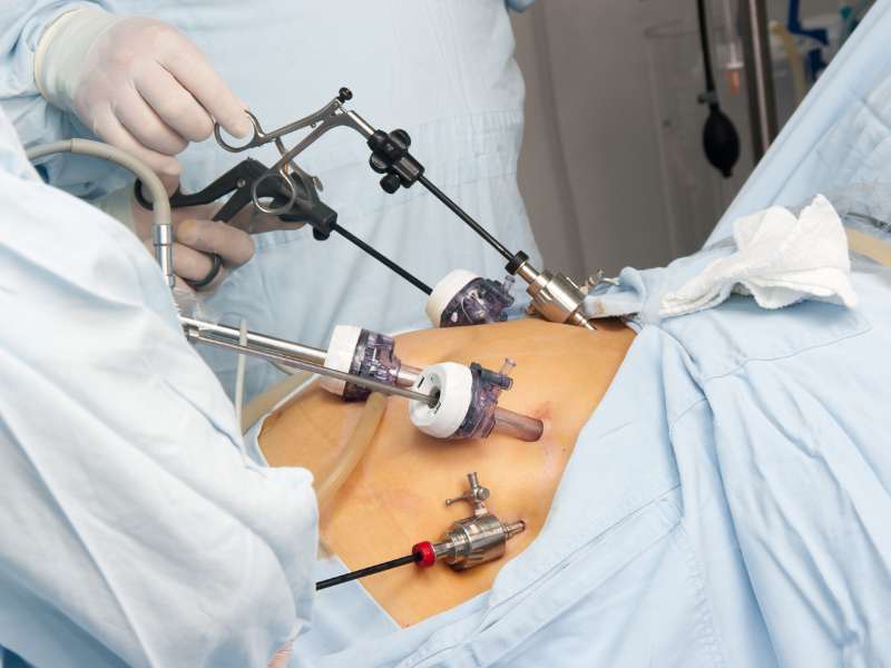Benefits of Laparoscopic Surgery in Delhi by Dr. Prashant Kumar