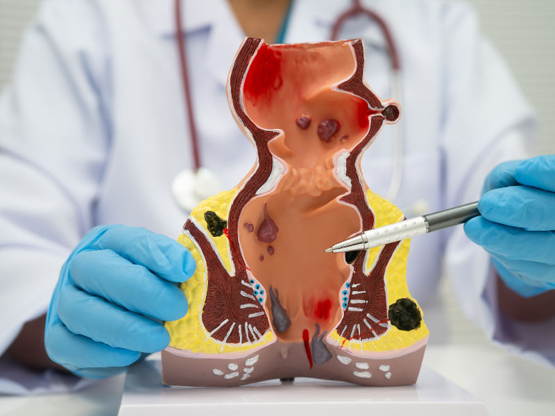 Proctologist in Delhi for Piles, Fissure and Fistula Treatment