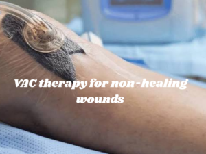VAC Therapy for Non-Healing Wounds: How Vacuum-Assisted Wound Care Works