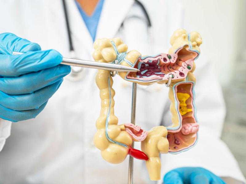 Colorectal surgery in Delhi for colon and rectal conditions