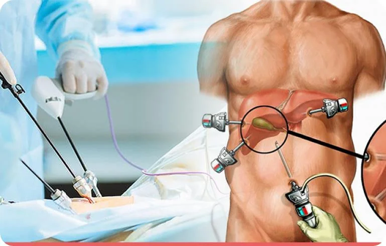 Gallbladder Stone Surgery placeholder