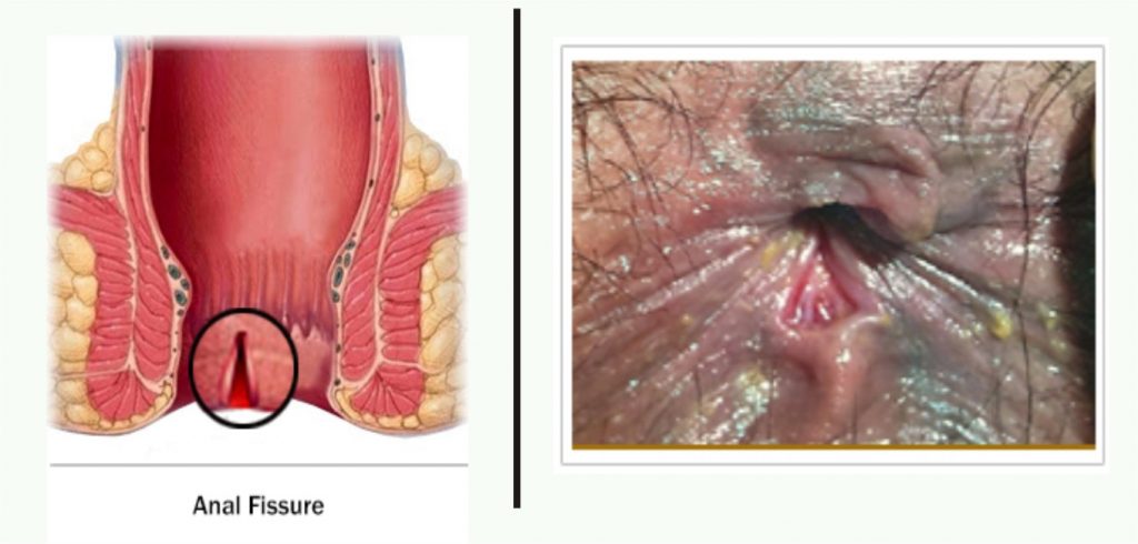 Fissure Surgery